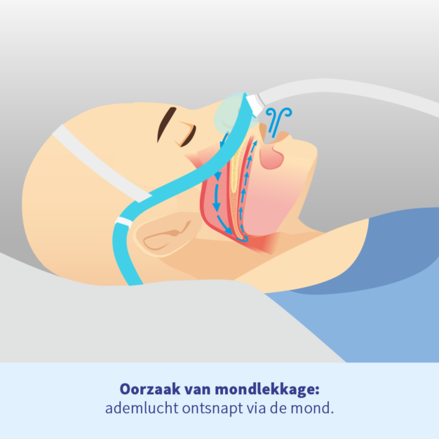 oxyhero CPAP pro tegen mondlekkage bij CPAP 3